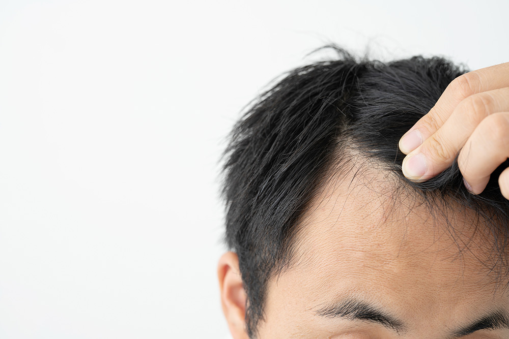 薄毛は分け目からも進行する 原因と対策を解説