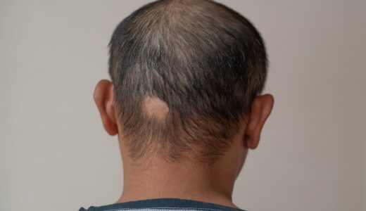 円形脱毛症の初期症状とは？原因や種類、対策方法も詳しく解説